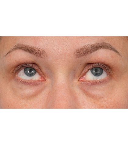 CO2 Laser Resurfacing Before & After Patient #3591