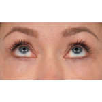 CO2 Laser Resurfacing Before & After Patient #3591
