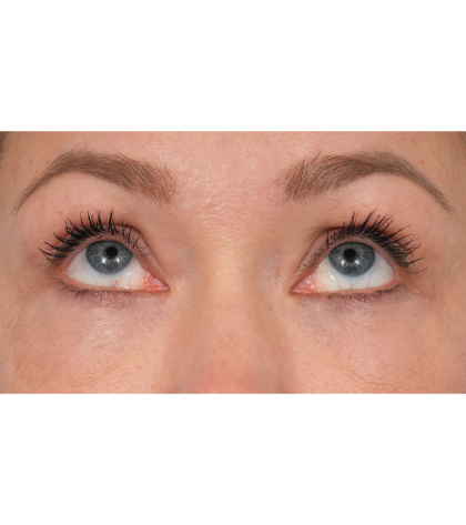 CO2 Laser Resurfacing Before & After Patient #3591
