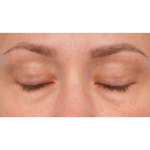 CO2 Laser Resurfacing Before & After Patient #3591