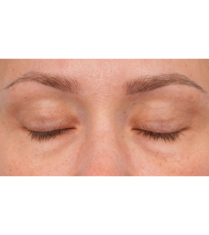 CO2 Laser Resurfacing Before & After Patient #3591