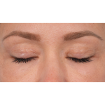 CO2 Laser Resurfacing Before & After Patient #3591