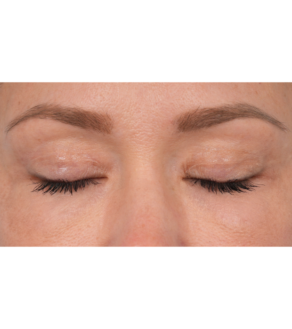 CO2 Laser Resurfacing Before & After Patient #3591