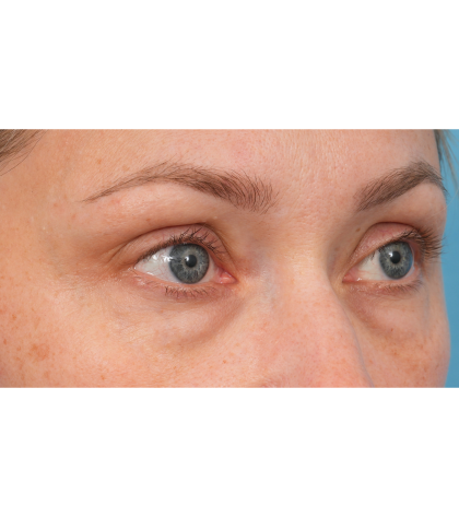 CO2 Laser Resurfacing Before & After Patient #3591