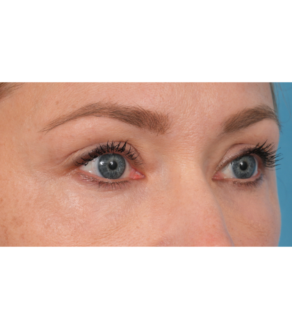 CO2 Laser Resurfacing Before & After Patient #3591