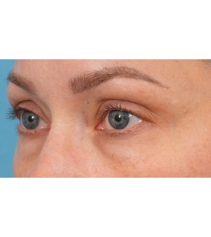 CO2 Laser Resurfacing Before & After Patient #3591