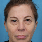 Quad Blepharoplasty Before & After Patient #3634