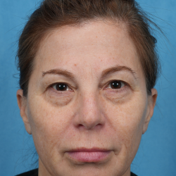 Quad Blepharoplasty Before & After Patient #3634