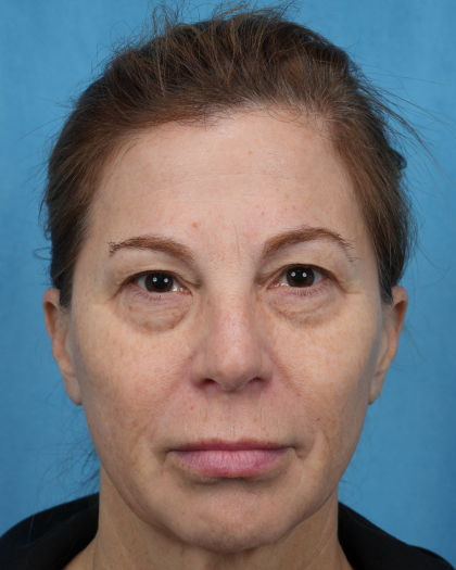 Quad Blepharoplasty Before & After Patient #3634
