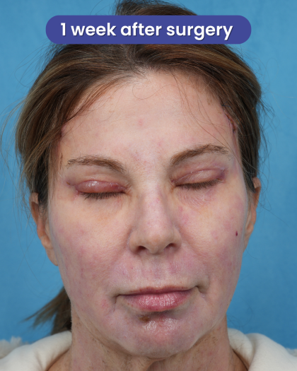Quad Blepharoplasty Before & After Patient #3634
