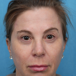 Quad Blepharoplasty Before & After Patient #3634