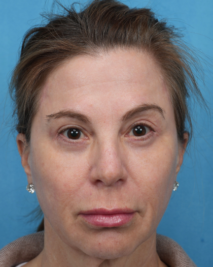 Quad Blepharoplasty Before & After Patient #3634