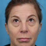 Quad Blepharoplasty Before & After Patient #3634