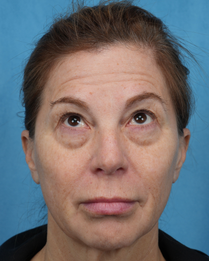 Quad Blepharoplasty Before & After Patient #3634
