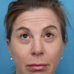 Quad Blepharoplasty Before & After Patient #3634