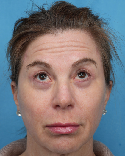 Quad Blepharoplasty Before & After Patient #3634