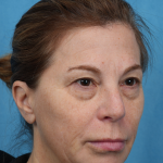 Quad Blepharoplasty Before & After Patient #3634