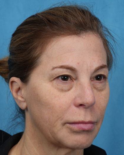 Quad Blepharoplasty Before & After Patient #3634