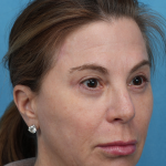 Quad Blepharoplasty Before & After Patient #3634