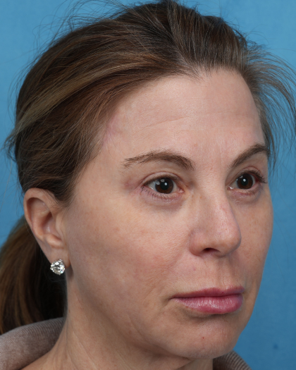 Quad Blepharoplasty Before & After Patient #3634