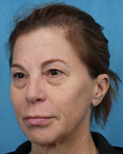 Quad Blepharoplasty Before & After Patient #3634