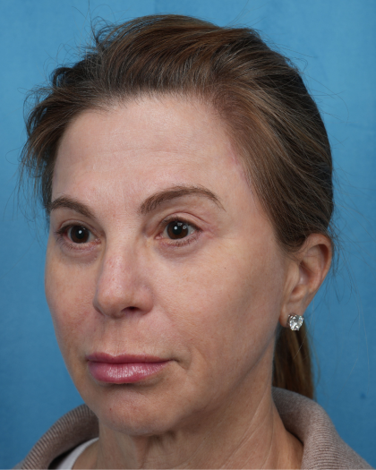 Quad Blepharoplasty Before & After Patient #3634