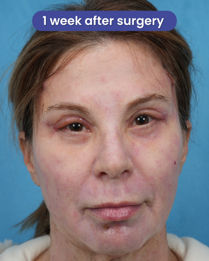 Quad Blepharoplasty Before & After Patient #3634