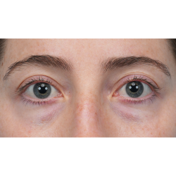 Lower Blepharoplasty Before & After Patient #3616
