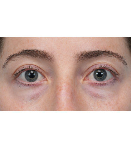 Lower Blepharoplasty Before & After Patient #3616