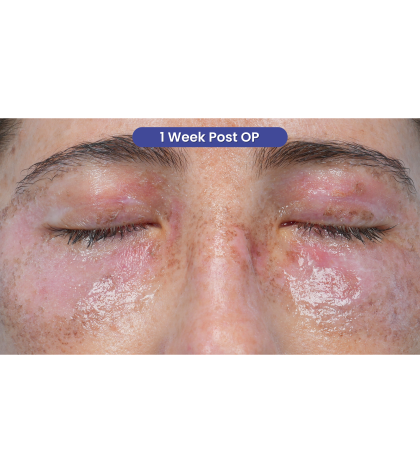 Lower Blepharoplasty Before & After Patient #3616