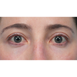 Lower Blepharoplasty Before & After Patient #3616