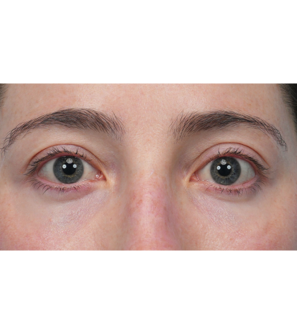Lower Blepharoplasty Before & After Patient #3616