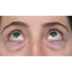 Lower Blepharoplasty Before & After Patient #3616