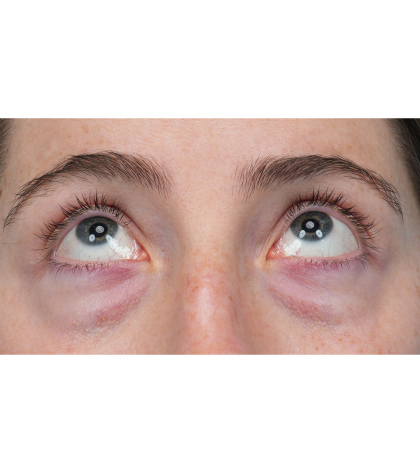 Lower Blepharoplasty Before & After Patient #3616
