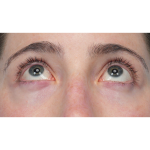 Lower Blepharoplasty Before & After Patient #3616