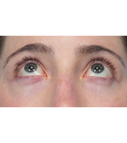 Lower Blepharoplasty Before & After Patient #3616