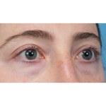 Lower Blepharoplasty Before & After Patient #3616