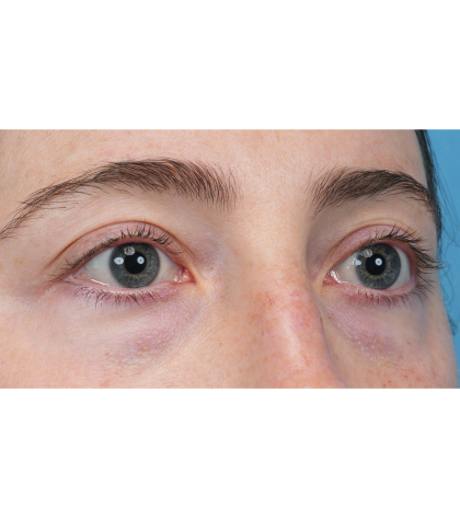 Lower Blepharoplasty Before & After Patient #3616