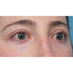 Lower Blepharoplasty Before & After Patient #3616