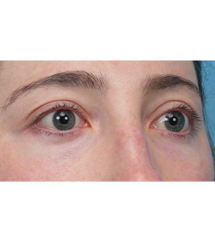 Lower Blepharoplasty Before & After Patient #3616