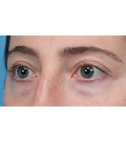Lower Blepharoplasty Before & After Patient #3616