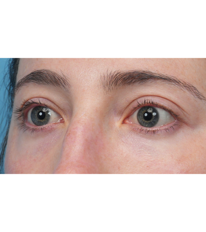 Lower Blepharoplasty Before & After Patient #3616