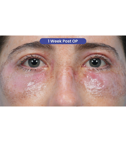 Lower Blepharoplasty Before & After Patient #3616