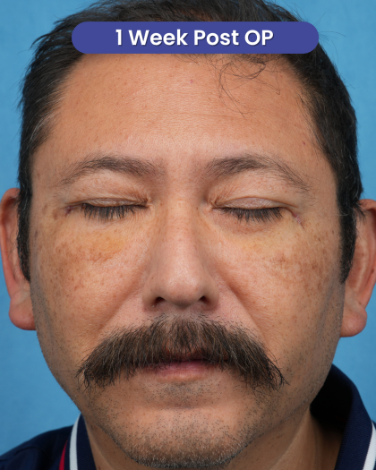 Lower Blepharoplasty Before & After Patient #3736