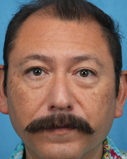 Lower Blepharoplasty Before & After Patient #3736