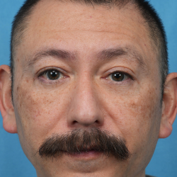 Lower Blepharoplasty Before & After Patient #3736