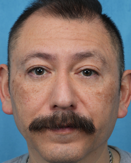 Lower Blepharoplasty Before & After Patient #3736
