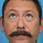 Lower Blepharoplasty Before & After Patient #3736