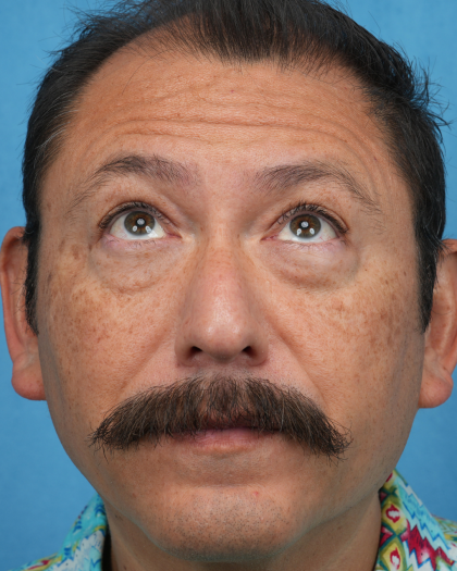 Lower Blepharoplasty Before & After Patient #3736