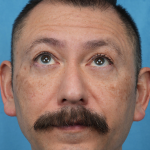 Lower Blepharoplasty Before & After Patient #3736